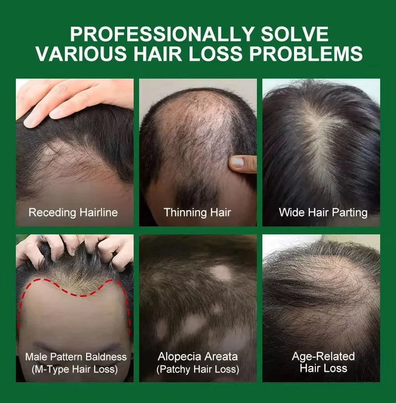 Fast Hair Growth Serum Spray | Anti Hair Loss & Baldness Treatment for Men & Women