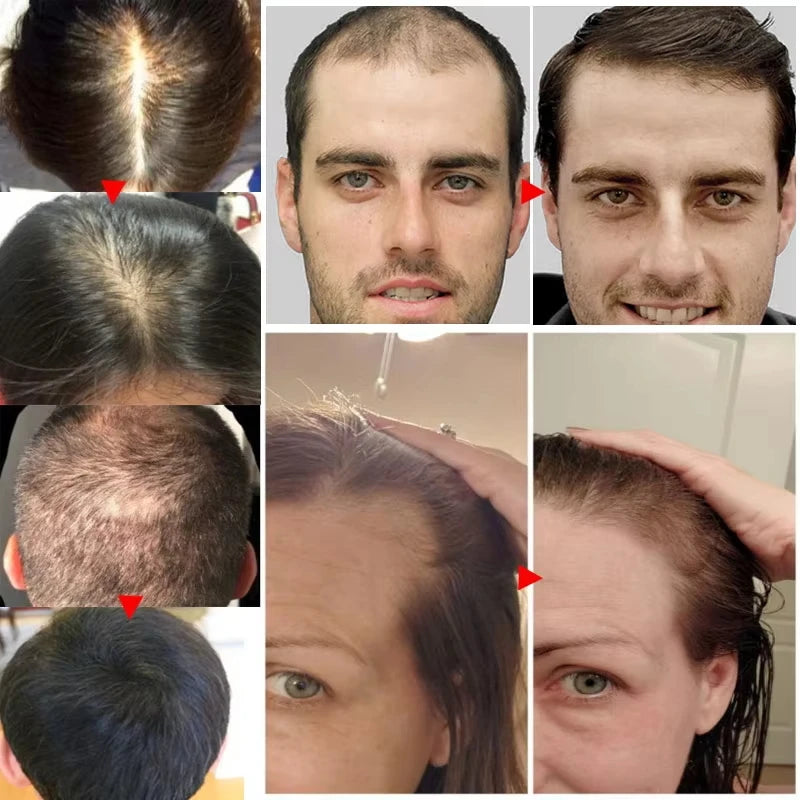 Fast Hair Growth Serum Spray | Anti Hair Loss & Baldness Treatment for Men & Women